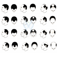 【佳學基因檢測】過早<font color='red'>脫發(fā)</font>、掉發(fā)太多怎么辦？你的方法可能是錯的！